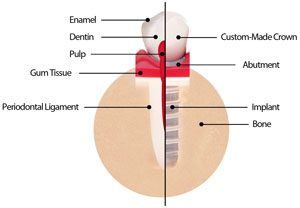 Details of a Dental Implant