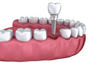 Implant Demonstration Image